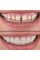 Виниры зубные Perfect Smile Veneers сменные белые