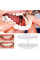 Съемные виниры на верхние и нижние челюсти накладные Smile Veneers с кейсом